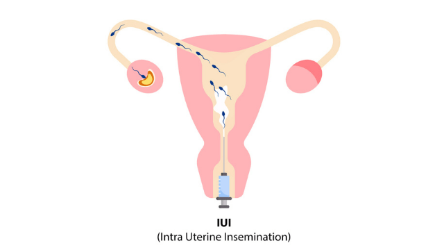 IUI