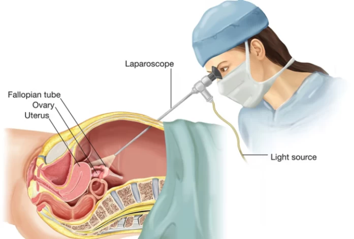 Laparoscopy
